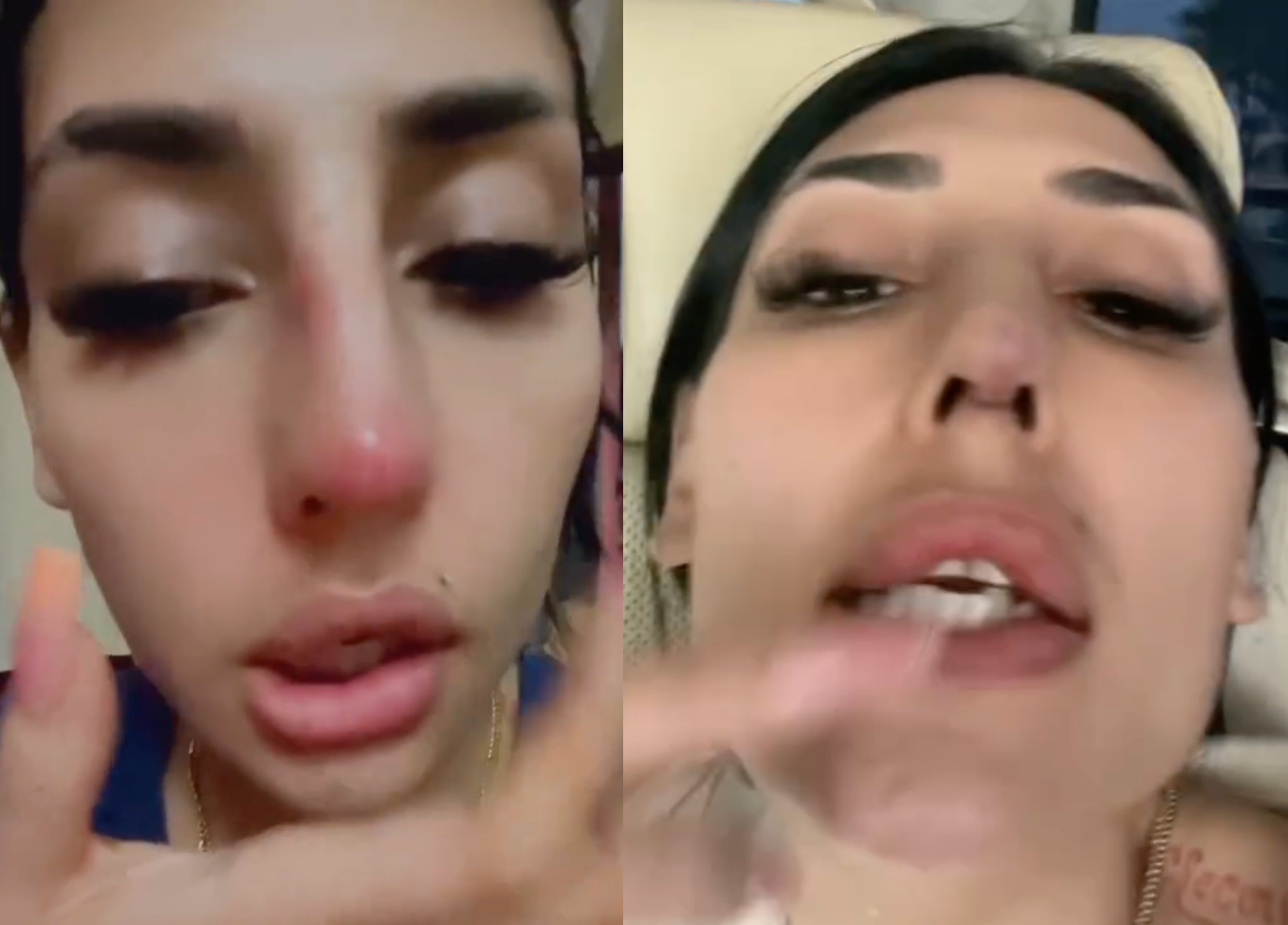 “Kena Jangkitan, Nanah Memancut” – Anju Menyesal Buat Hidung